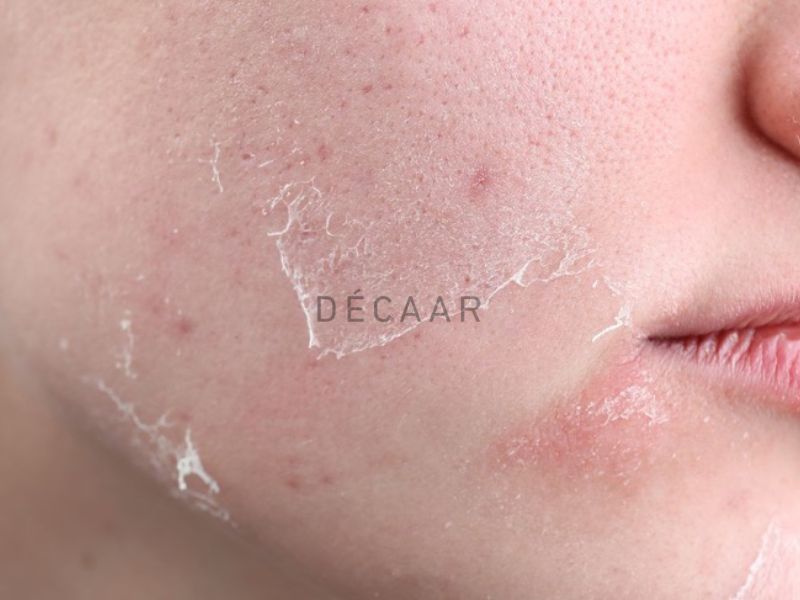 Nguy cơ tẩy tế bào chết sau peel